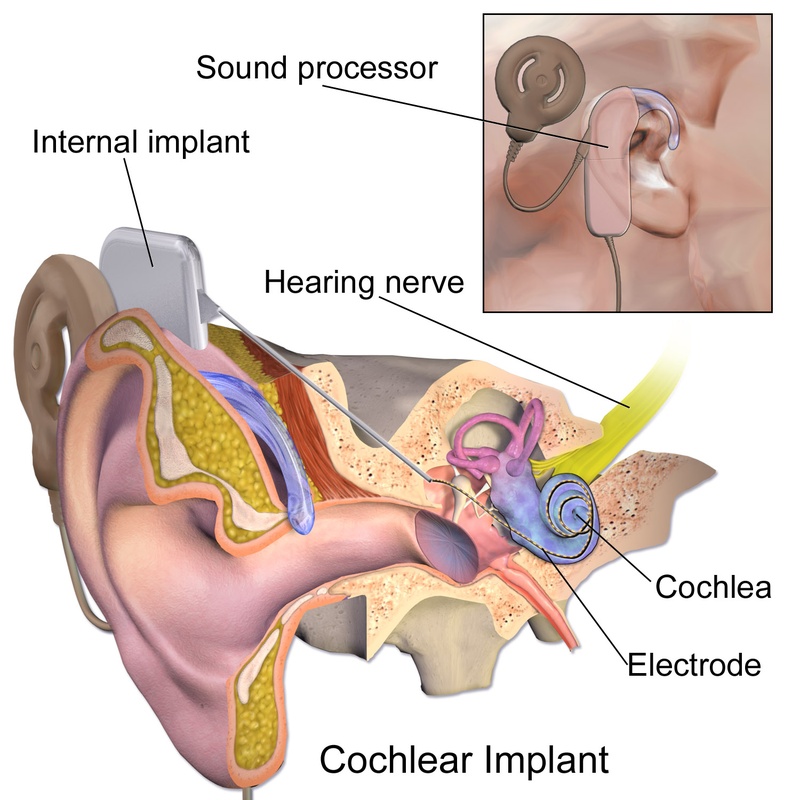 Think of it like a hearing aid that bypasses damaged ears entirely—this cochlear implant diagram shows how bioelectronic medicine works by directly stimulating neural circuits with electrical signals. Rather than chemically altering brain chemistry like pharmaceuticals, bioelectronic devices target specific nerve pathways with precision. The cochlear implant represents bioelectronic medicine's greatest clinical success—over 1 million patients worldwide have received these devices, proving that electrical therapy can restore function more effectively than any drug for certain conditions.